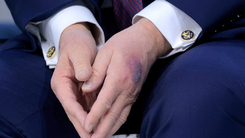 trump-bruise-hand-13.jpg-13